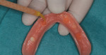 Fig 5. Recesses to accommodate the denture attachment housings were filled with a flowable, light-activated composite.