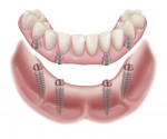 Fig 4. The unique design of the fixed attachment system in this study accommodates divergent/convergent scenarios up to 40° between implants, without the need for angled abutments.