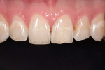Figure 8  This before and after comparison shows that optimal periodontal tissue health was supported and the gingival zeniths were positioned just distal of center, creating a converging axial inclination. Central incisors revealed symmetrical conto