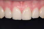 Figure 9  This before and after comparison shows that optimal periodontal tissue health was supported and the gingival zeniths were positioned just distal of center, creating a converging axial inclination. Central incisors revealed symmetrical conto