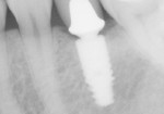 Figure 3  Platform switching and complete surface conditioning encourages the bone to osseointegrate over the superior surface of the implant fixture.