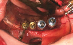 Figure 15f  Placement of four implants,as per virtual treatment plan, Nobel-Guide secured in place.