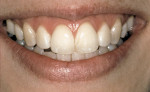 Figure 1  Teeth and gingiva had a very prominent appearance in this patient with a high smile line. Combined with a thin gingival morphotype, treating this patient with any type of restorative procedure in this area would require flawless execution.