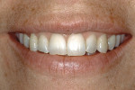 Figure 2  A broad smile revealed the mesiobuccal line angles of both maxillary first molars.