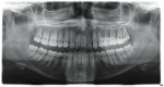 The initial panoramic radiograph revealing the macrodontic single central.