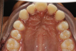 Patient presented with an oversized single central incisor and a desire for a more “normal” appearing smile.