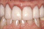 Figure 3  Note how the viewer is drawn initially to the maxillary right lateral incisor due to its excessive length caused by the apical position of the gingival margin. There were also multiple other problems with these restorations including long c