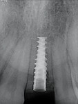 Radiographs of implant placement.