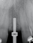 Radiographs of implant placement.