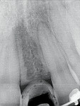 The resultant space and root angulations after bodily movement of the adjacent teeth.