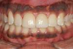 Insertion of veneer and implant crown with compromised size differential.