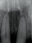Note the tipping caused by chaining of the central incisors and inadequate space for implant placement in the No. 10 position.