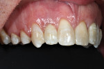 Placement of final restorations.