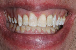 Final results. Patient loves his new smile.