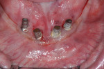 Poor plaque control around mandibular anterior dental implants.