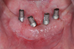 Free gingival graft was used to increase the width of keratinized tissue and enhance the tissue quality.