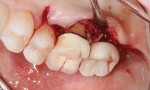 Excess cement remnant present on the mesial surface of implant No. 2, leading to a pocket formation and bleeding on probing.