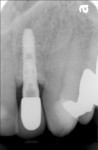 Radiographic and clinical evidence of bone fill at 6 months after regenerative surgery. Note the stability of the crestal bone at the implant-abutment connection after 2.5 years.