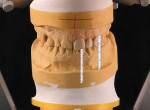 Wax-up created to improve tooth proportions with crown lengthening and to assess treatment options.
