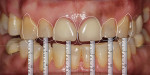 Revised smile design without anterior crown lengthening, per patient’s request.