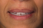 Provisionals showing incisal exposure with the lips at rest.