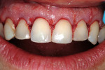 Figure 11  Post-esthetic crown lengthening demonstrates how short the original composite veneers were from the cementoenamel junctions of the lateral incisors and canines.