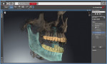 The SICAT Function is a software solution that provides individual patient information to the CEREC articulator for treating complex restorative cases, resulting in a better design proposal that minimizes chairside adjustments and enhances the patient’s experience.