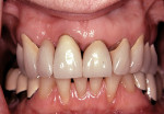 Figure 14  Note the Seibert Class 1 ridge defect in the maxillary right lateral incisor area, the uneven gingival margins, and the root exposure subsequent to resective periodontal surgery.