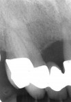 Figure 15  Periapical radiographs showed significant bone loss on the maxillary right central incisor. With better bone around this tooth, forced orthodontic eruption could be considered.