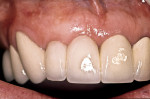 Figure 17  The final restoration at the time of treatment shows good emergence profile and interdental papillae for the ovate pontics of the right central and lateral incisors. Restorative dentistry by Dr. Joseph Portera, Jackson, Mississippi.