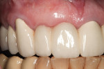 Figure 18  A 15-year follow-up of ridge reconstruction shows dimensional stability possible with autogenous connective tissue grafts. The reconstruction has been replaced with slight loss of the interdental papillae. Restorative dentistry by Dr. J. D
