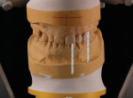 Fig 7. Wax-up created to improve tooth proportions with crown lengthening and to assess treatment options.