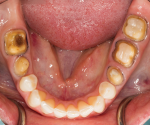 Fig 11. Dentition when final impressions taken.