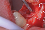 Fig 6. Removal of the granulation tissue with a metal curette.