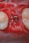 Fig 5. After flap elevation, granulation tissue surrounding the implant was evident.