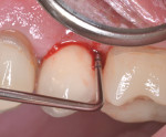 Fig 1. Preoperative photograph showing deep PD and bleeding of the distal-buccal site.