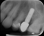 Fig 2. Preoperative periapical x-ray showing circumferential bone loss around the implant.