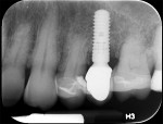 Fig 17. Periapical x-ray 12 months post-surgery.