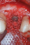 Fig 8. After degranulation and decontamination, the defect was grafted with demineralized freeze-dried bone allograft and covered with a polylactic acid resorbable membrane.