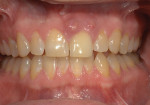 Fig 1. Preoperative retracted view showing gingival infection of the maxillary left central incisor.
