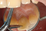Fig 2. Horizontal fracture of the maxillary left central incisor.