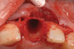 Fig 5. An example of a thin facial plate after an anterior tooth extraction. This image is from a different case.