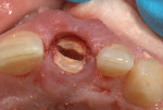 Fig 7. Longitudinal sectioning of the root into labial and palatal halves.