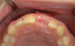 Fig 10. Occlusal view of the maxillary left central incisor after 3 months of healing.