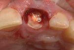 Fig 6. The root remaining after decoronation of the nonrestorable tooth.