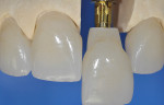 Fig 11. A translucent zirconia core crown overlaid with porcelain prior to extracoronal
bonding over an anodized abutment (photograph courtesy of laboratory technician Jurijs Avots).