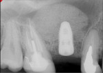 Fig 3. Radiograph after implant placement.