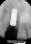 Fig 12. Periapical radiograph taken at implant uncovery after 3 months of healing, demonstrating bone fill around the implant.