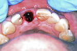 Fig 8. Atraumatic removal of central incisor.