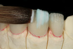 Figure 11  The segments of IPS e.max enamels OE1 (Opal Clear Blue color tagged) and TI1 (incisal 1) were applied and built up.